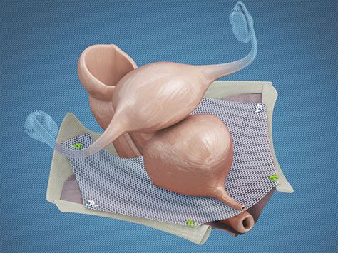 Pelvic Floor Reconstruction Reconstruction Mesh Ingynious Ami Agency For Medical