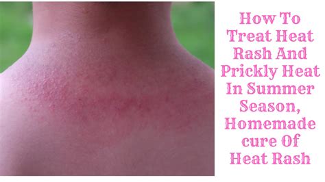 How To Treat Heat Rash And Prickly Heat In Summer Season Homemade Cure