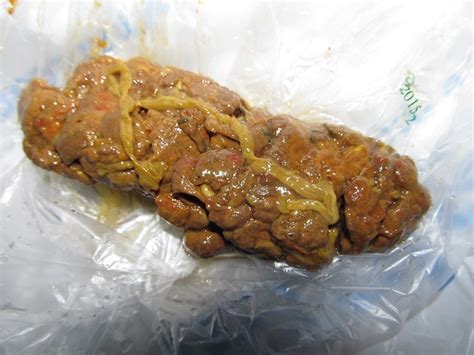 I ended up having abdominal surgery and six months of chemotherapy with a chest. IMG 0209sm2 On CureZone Image Gallery