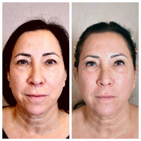 Potenza Microneedling Review Before And After Pictures Romy Raves