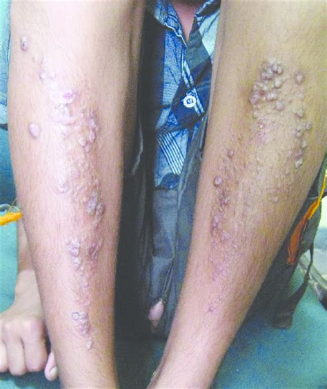 Skin Colored And Hyperpigmented Papules And Nodules Over Bilateral