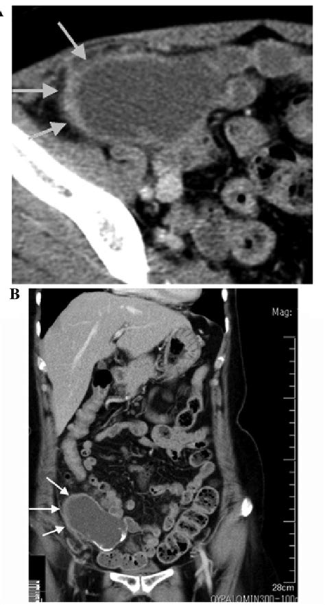 Abdominal Computed Tomography Ct Scans Obtained In August 2012 Axial