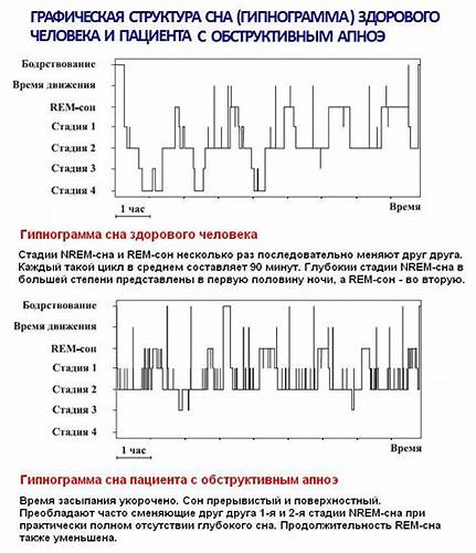 Диета при апноэ сна Структура сна в норме и при обструктивном апноэ Структура сна в норме и при обструктивном апноэ Диета при апноэ сна