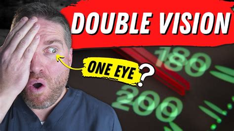 5 Causes Of Double Vision In One Eye Monocular Diplopia Youtube
