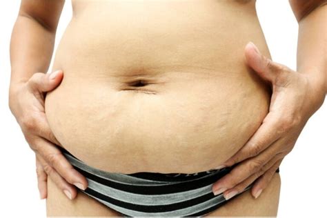 Stomach Stretch Marks Causes Remedies And Treatments That Work