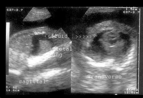 Fetal Pleural Effusion Ultrasound