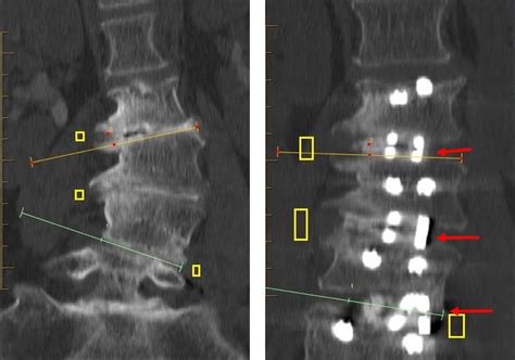 Cureus Minimally Invasive Scoliosis Surgery With Oblique Lateral