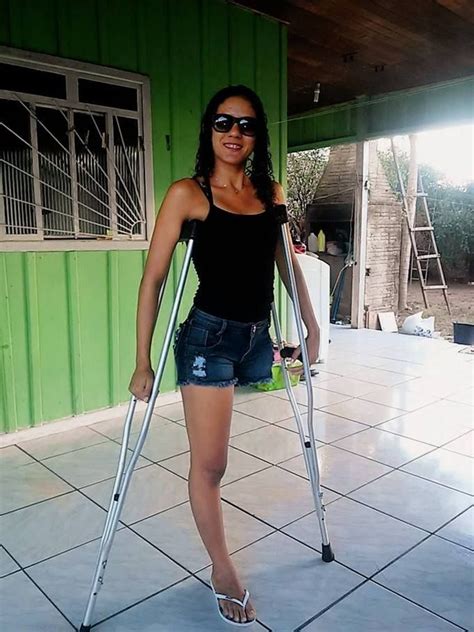 Broken Leg Cast Amputee