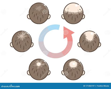 Information Chart Of Hair Loss Stages Types Of Baldness Illustrated On