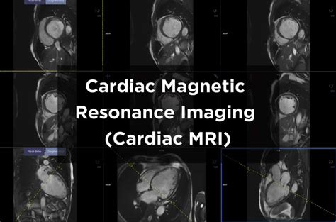 Cardiac Magnetic Resonance Imaging Mri Scan Bangkok Hospital Phuket