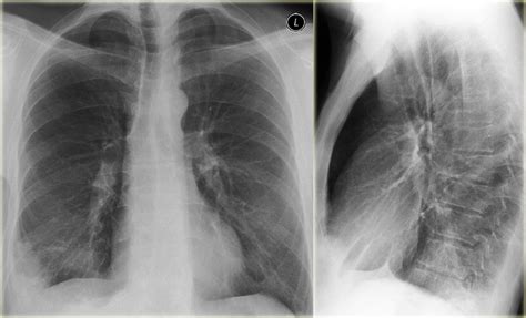 Lung Infarction The Radiographic Features Of Acute Grepmed