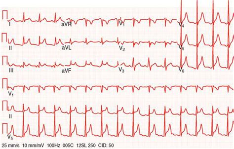 Pericardial Disease