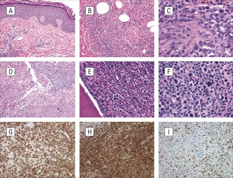 Primary Cutaneous T Cell Lymphoma Localized To The Lower Lega Distinct