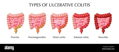 Ulcerative Colitis Types Infographics Including Proctitis Distal