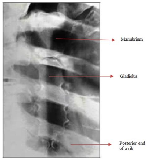 A Section Of The Right Anterior Oblique View Of The Chest X Ray To