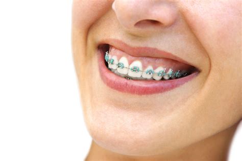 5 Easy Steps On How Braces Work Creed Orthodontics Cypress Texas