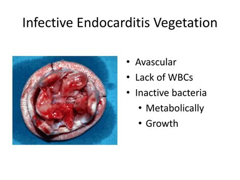 Ppt Treatment Of Infective Carditis And Rheumatic Heart Disease