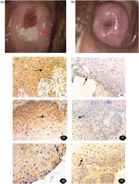 A The Cervical Appearance Of A Patient Under Colposcopy Before Download Scientific Diagram