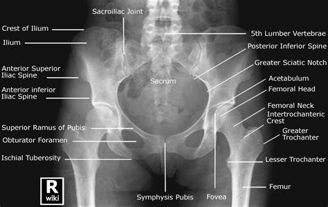 Radiographic Anatomy Pelvis Ap Female Radiology Student Medical