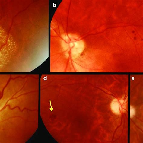 Color Fundus Photography Ocular Findings Of Patients In The Uci A