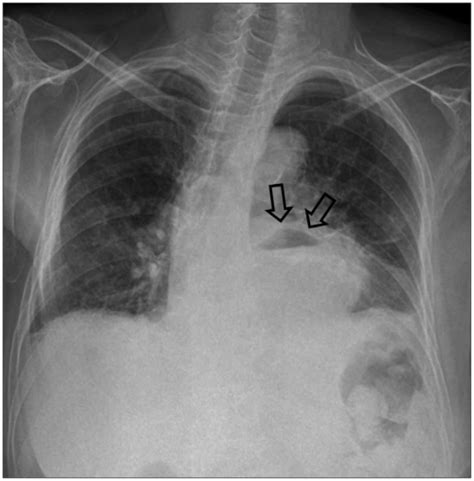 Chest X Ray Showing Air Fluid Level That Suggest Large Open I