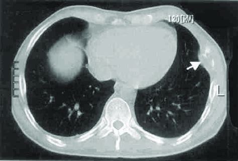 Computed Tomography Of The Thorax Shows Osteolytic Lesions On The