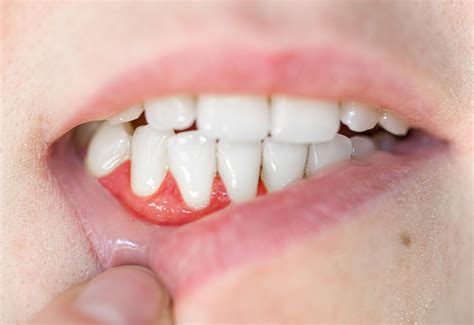What Are The Common Symptoms Of An Advanced Gum Abscess Home
