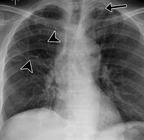 Positive Tb X Ray Images Mageusi