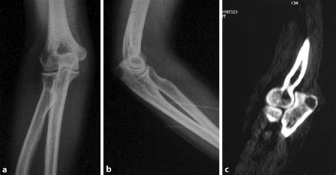 8 A Anteroposterior Plain Radiograph Of The Right Elbow Indicated That