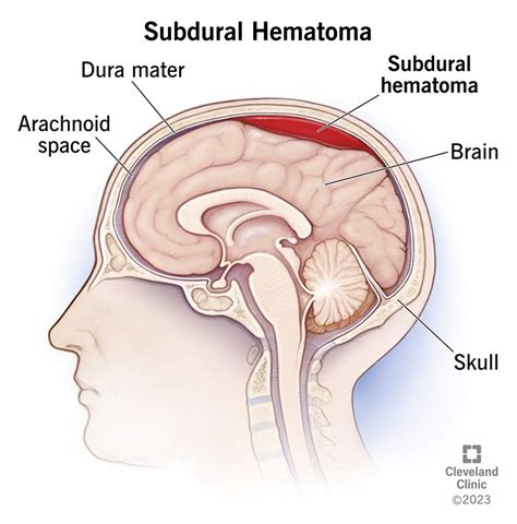 Subdural Hematoma Vs Subarachnoid Hemorrhage