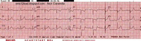 66 Year Old Female Cc Chest Pressure Conclusion Ems 12 Lead