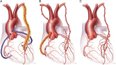 Conduits In Coronary Artery Bypass Grafting Seminars In Thoracic And