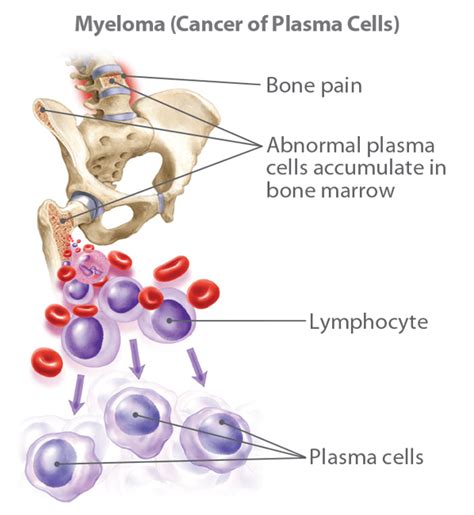 Multiple Myeloma Causes Symptoms And Treatments