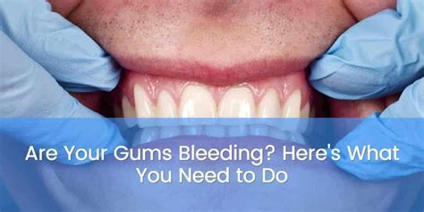 Are Your Gums Bleeding Heres What You Need To Do La Dental Clinic