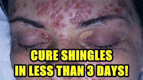 Shingles Treatment 2018 Cure Shingles On Face And Shingles In The
