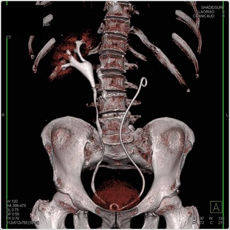 Stent In Left Renal Pelvis In 3d Kidney Case Studies Ctisus Ct Scanning