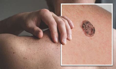 Skin Cancer Symptoms What Does Skin Cancer Look Like 10 Signs To Get Checked Uk