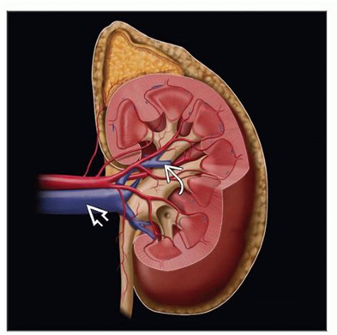 Introduction To Kidney Tumors Basicmedical Key
