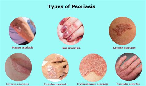 Psoriasis Rash Pictures Symptoms