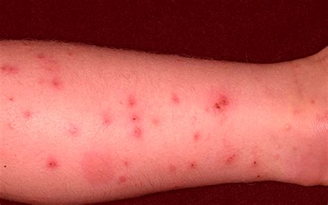 Flea Bites On Humans Symptoms Treatment Pictures
