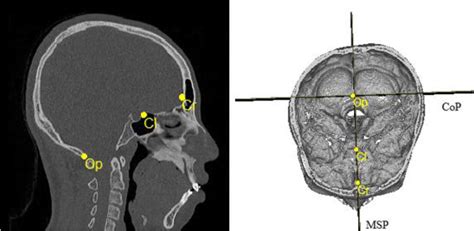 Three Dimensional Computed Tomography Evaluation Of Craniofacial