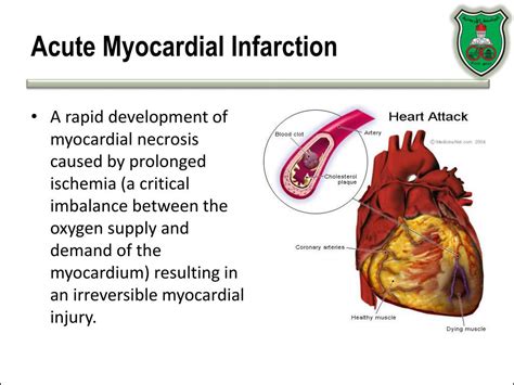 Myocardial Infarction Photo