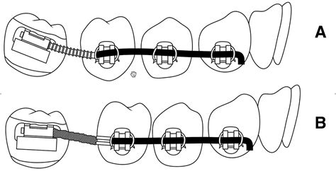 How To Upright A Mesio Angulated Impacted Second Molar In Orthodontics