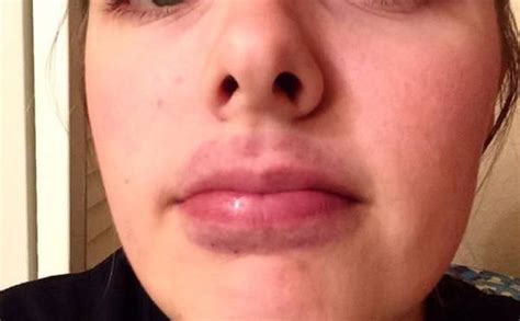 How To Get Rid Of A Bruised Lip Treat Swollen Lips Kylie Jenner