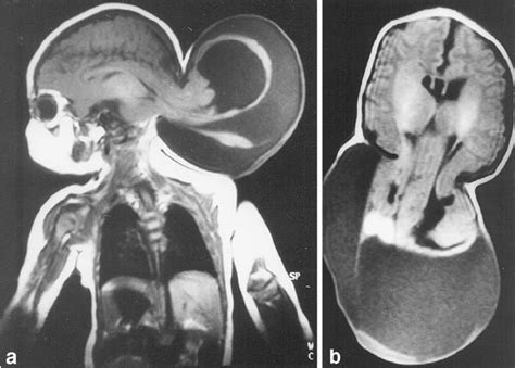 Case 2 Preoperative Sagittal T1 Image Showing A Large Occipital