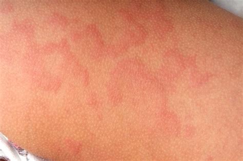 Hives During Pregnancy Causes Treatment And Prevention