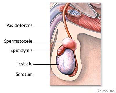 Spermatocele Testicular Cysts Hot Sex Picture
