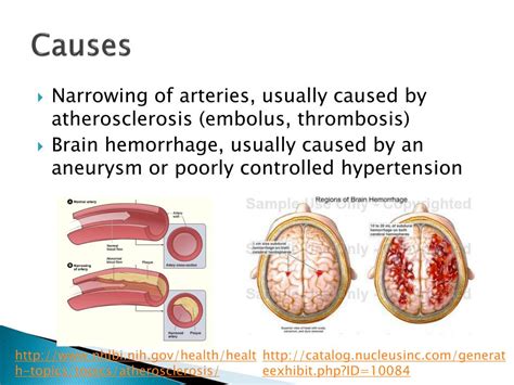 Ppt Cerebral Ischemia Powerpoint Presentation Free Download Id2312781