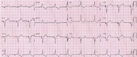 Twelve Lead Electrocardiogram During Biventricular Pacing Download