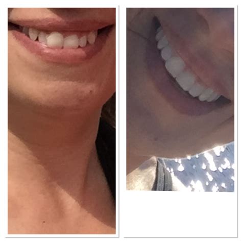 My Smile Direct Club Results Use My Link To Receive 50 Off Your